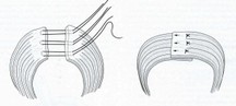sfinteroplastica anteriore